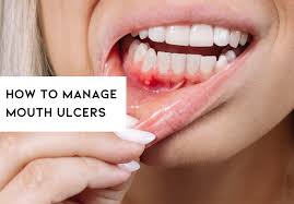 Understanding and Managing Mouth Sores: Causes, Remedies, and Prevention